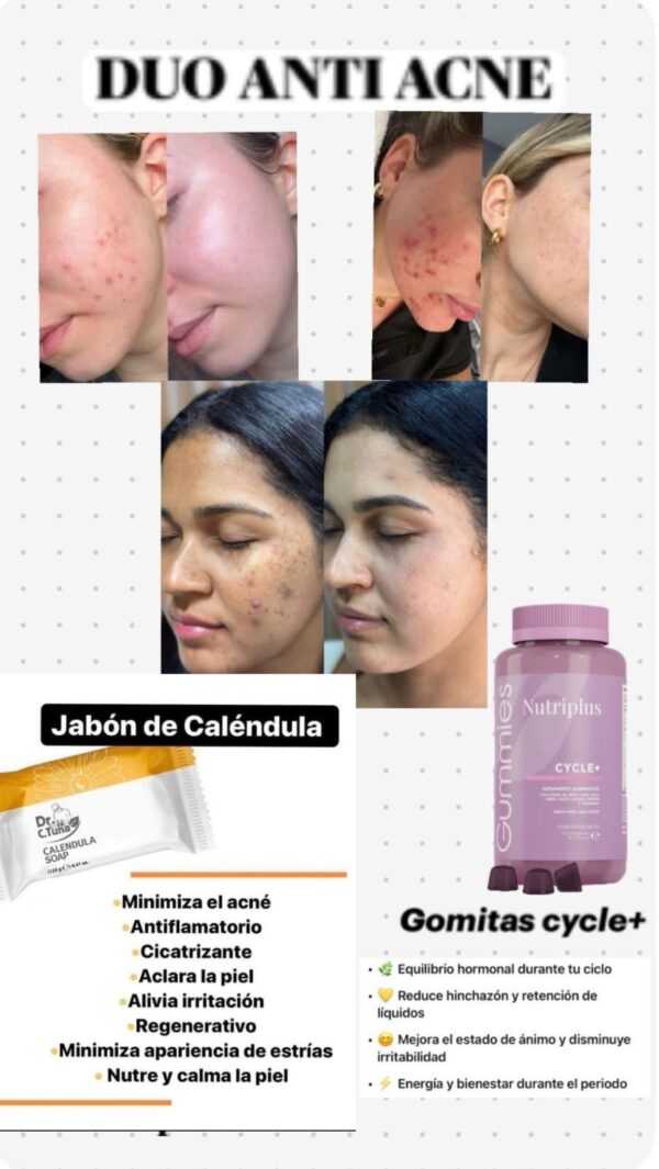 TRATAMIENTO PARA EL ACNE